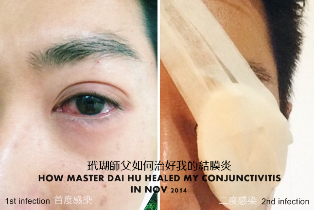Master Dai Hu Alternative Treatment Healing Ability Power Eyes conjunctivitis  加持結膜炎眼睛玳瑚師父新加坡 Singapore