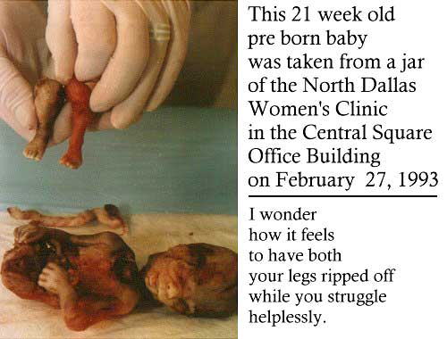 Abortion